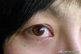 实实在在回答“提眉手术”的几个问题，一般人我可不会告诉图片
