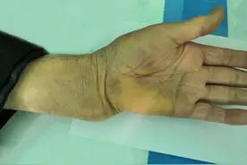 系统讲解最常见的骨折之一桡骨远端骨折图片