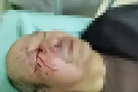 23年73岁老兵被养老院护工打爆眼球，院方：我们是日本管理理念！图片