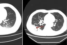 吹了3天空调，男子左肺“白”了一半！这个关键，很多人都忽略了......图片