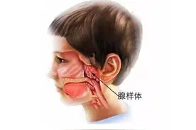 【科普系列】什么是腺样体肥大图片