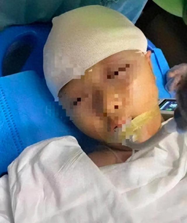 长沙被打破头骨女孩称因学生吵闹老师掀翻桌子，两次故意用三角尺砸人，家属：孩子晚上常做噩梦喊“别打我”