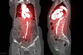 心脏放了支架能维持多少年？有没有保质期？医生给出了明确答案图片