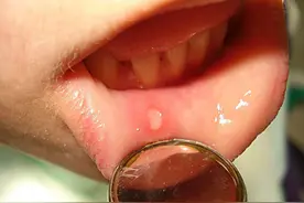 反复口腔溃疡、甚至生殖器溃疡？或是惹上这种病图片