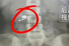 会“唱歌”的肚子！男子误吞蓝牙耳机胃里放音乐：自称戴耳机睡觉图片