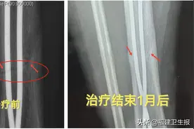 福建女孩骨折后长期不愈合，康复科医生用1招轻松解决！还能治多种疼痛图片