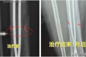 福建女孩骨折后长期不愈合，康复科医生用1招轻松解决！还能治多种疼痛图片