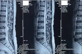 不想手术：腰痛，左侧坐骨神经痛，跛行，腰4-5椎间盘突出症图片