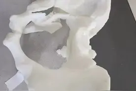 高处坠落，70岁大爷右侧髋臼粉碎性骨折！“3D打印”帮解决……图片