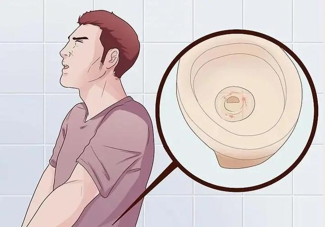 膀胱癌的早期症状有哪些,你知道吗?