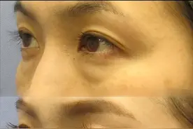 别随便做眼袋手术！分享我做祛眼袋手术的经历，以及常见的问题图片