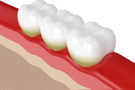 健康早知道：除了槟榔，导致口腔癌的因素还有哪些？图片