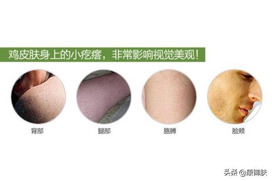 鸡皮疙瘩上抠出颗粒