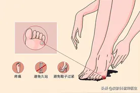 什么是鸡眼、跖疣、胼胝？有什么区别？听听医生怎么说图片