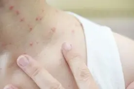 荨麻疹是怎么产生的？医生：多半与4个因素有关，别傻傻往上撞图片