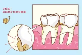 洗完牙没多久又有牙结石？图片