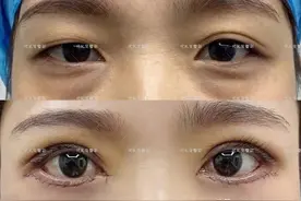 49岁做了全切双眼皮和外切去眼袋，作为过来人给大家讲讲感受图片