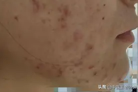 解决“难治性痤疮”的方子，去痰湿，解邪毒，请你收藏图片