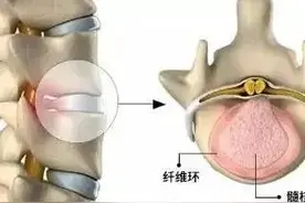 腰椎间盘突出和腰椎间盘突出症是一回事吗？图片