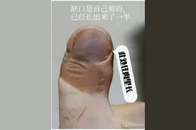 指甲往肉里长怎么办？五毛钱搞定图片