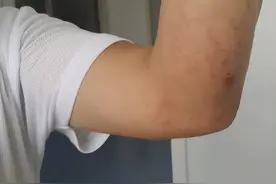 一旦感染艾滋病，多久能被发觉？可能多数人以为是皮肤病，要分清图片