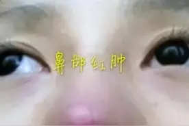 科普：隆鼻之后多久可以正常的捏鼻子？会发红吗？图片