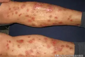 小腿长了很多红色肉疙瘩很痒怎么办图片