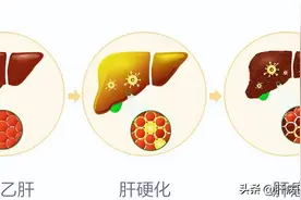 乙肝到肝硬化是必然还是偶然？图片