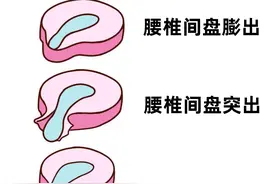 腰椎间盘膨出、突出、脱出，哪种情况就要手术了？图片