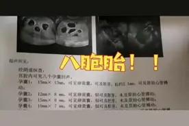 2.7亿人围观郑州孕妇怀8胞胎，医生说太危险了，为何这么多？图片