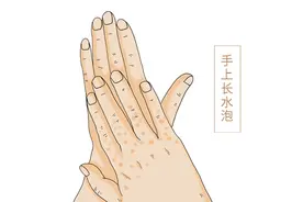 手上起很痒的小水泡是怎么回事？是脚气感染吗？医生告诉你图片