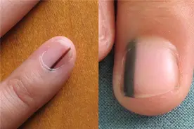 体内有癌，指甲先知？6种症状，可能是癌或疾病的征兆，留心观察图片