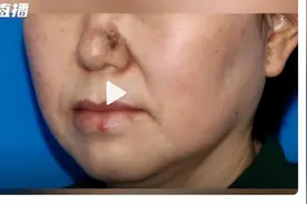 鼻子周围有这样的“黑头”就要小心了，它可能是皮肤癌！图片