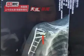 女子术后3年发现骨头中遗留金属钻头，质疑医院有意隐瞒索赔20万；医院：建议诉讼解决，承担该承担的费用图片