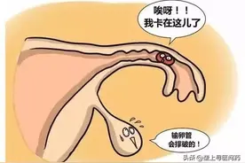 30岁女士喝冰水后肚子剧烈疼痛，原因竟然是异位妊娠图片