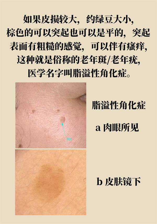 脖子上的小肉揪是疣吗?专家支招科学祛除