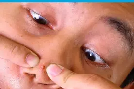 鼻周长痘=肾虚？这几个真相你一定要知道图片