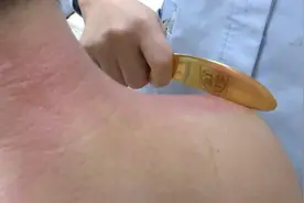 健康科普︱“虎符”可治病！虎符铜砭刮痧了解一下图片