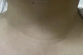 女子经常熬夜脖子变粗，一查患上癌症！当心，熬夜让内分泌紊乱易患肿瘤图片