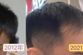 南京小伙走“头”无路花2万5植发，初见效果又担心只是昙花一现…图片