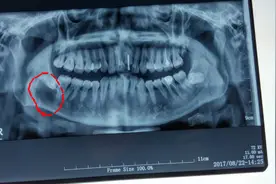 牙齿疼痛几月，查出囊肿！出现这几个情况，可能是大病征兆图片
