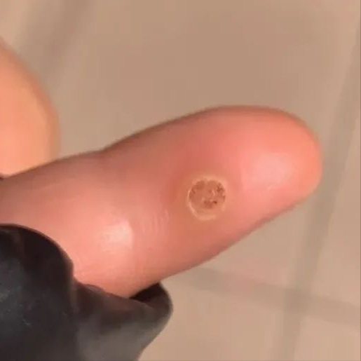 角化棘皮瘤的病理要点