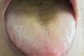 肠炎拉肚子，大便清稀臭秽，肛门灼热，湿热腹泻，四味药全搞定图片