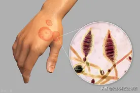 皮肤科医生和你聊聊：常见的真菌性皮肤病如足癣为什么容易复发？图片