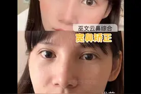 巫文云【宽鼻缩窄】案例分享视频封面