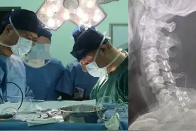 西安市第三医院成功实施首例脑卒中偏瘫SCS手术 点亮患者新希望图片