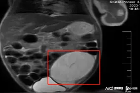 出生13天，早产儿确诊先天性卵巢囊肿！医生：病情较为罕见图片