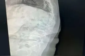 台州61岁大妈突然“长高”12厘米！原因竟是…图片