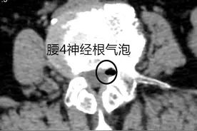 别再忍了！宁德一阿姨腰痛腿麻误以为腰椎间盘突出，一查竟是……图片