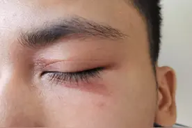 当心隐翅虫！南宁一个男生宿舍全部“中招”图片